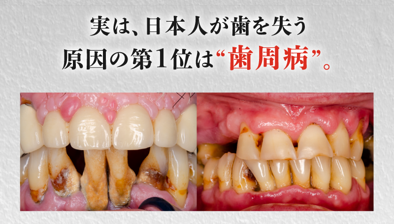 日本人が歯を失う原因の1位は歯周病
